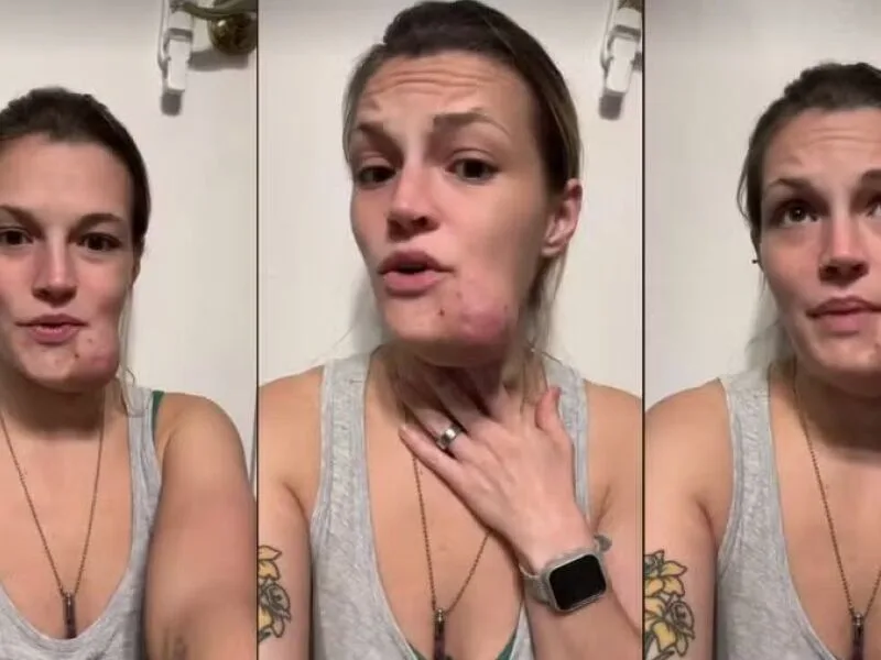 Hemangioma de Hope Schiefer avança até o pescoço após 19 anos