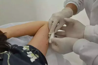 SUS ajusta faixa etária registrada para uso do implante Implanon