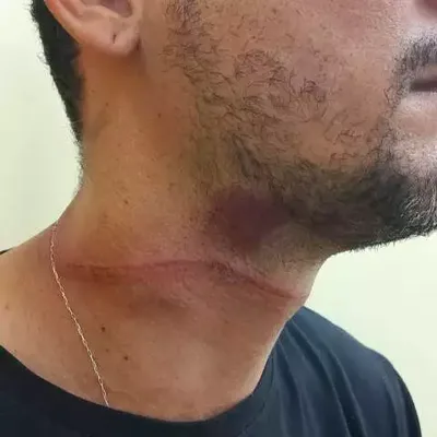 Cozinheiro sofre queda após cabo de telefonia atingir moto em Campo Grande
