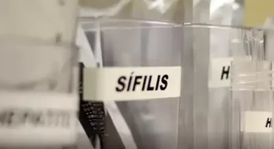 Sífilis: quem tem vida sexual ativa deve fazer teste anual