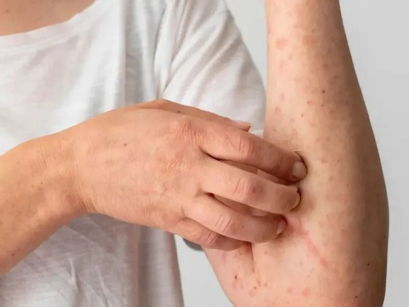 Coceira e feridas tornam dermatite atópica um desafio além da pele