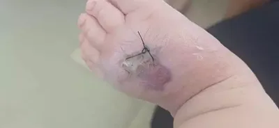 Picada de aranha leva bebê à internação e causa necrose no pé